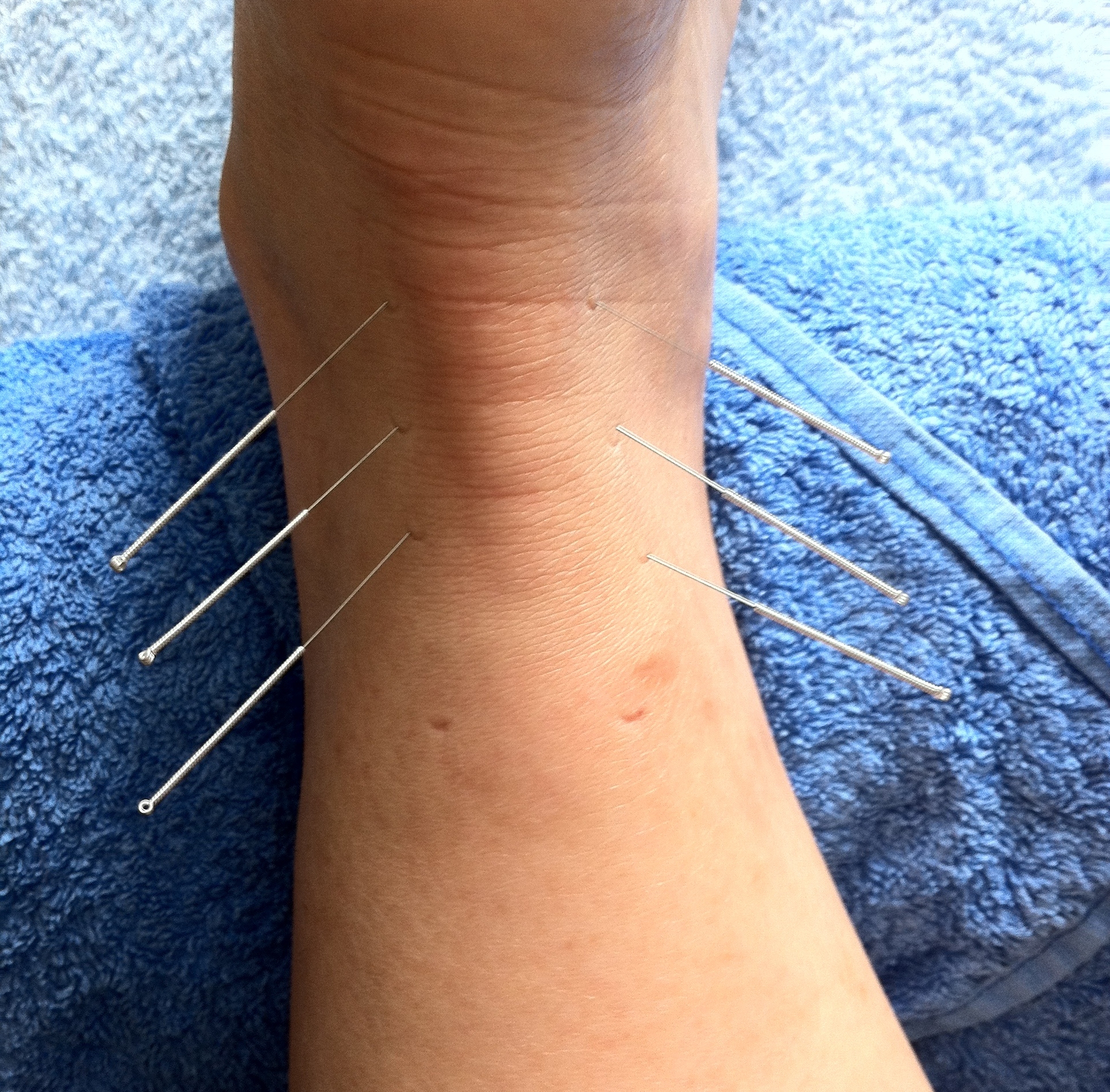 acupuncture in ankle points